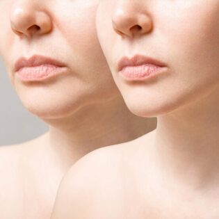 double chin reduction