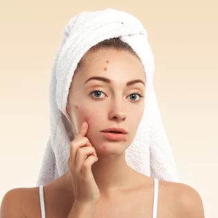Pimple treatment